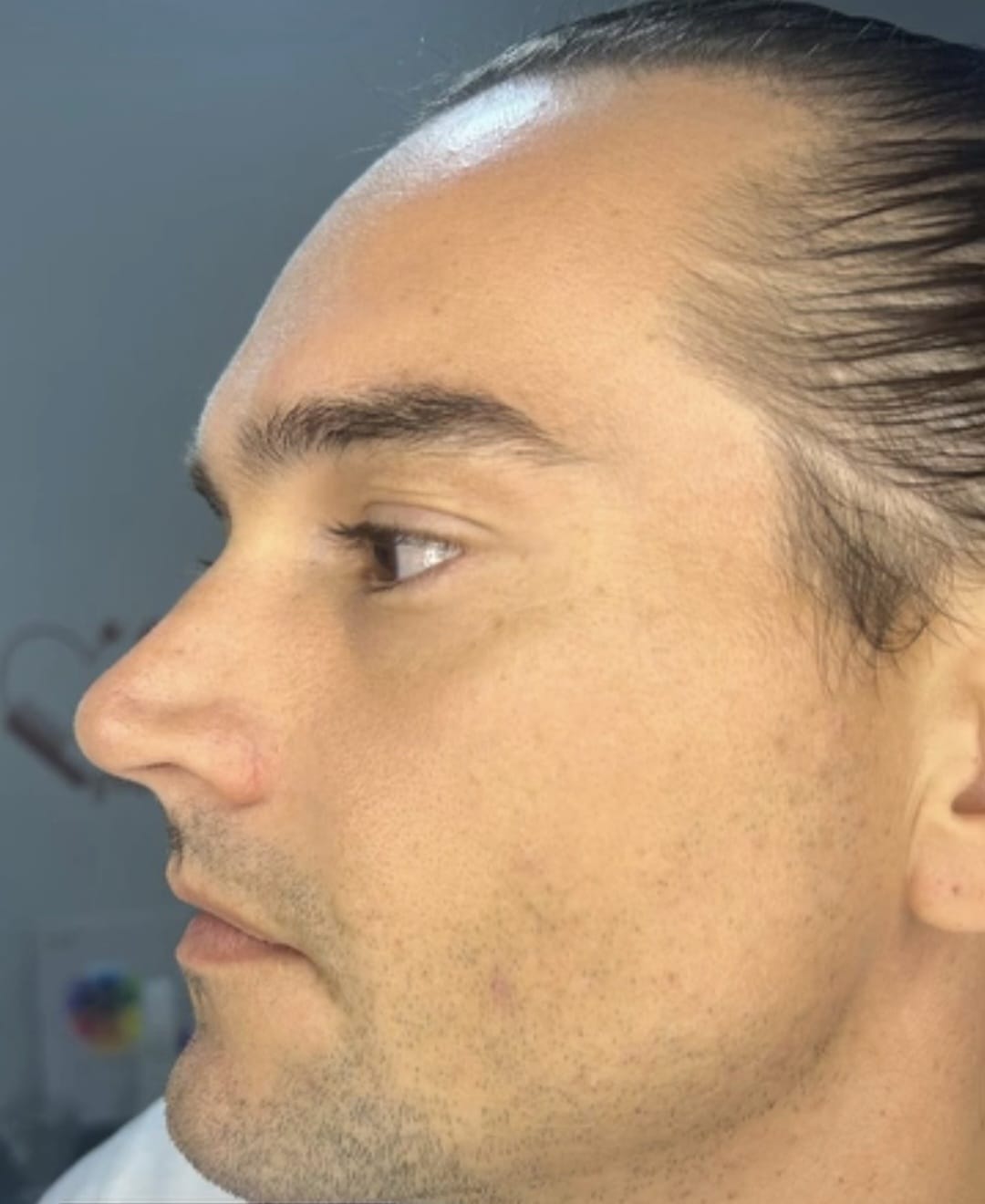 Botox