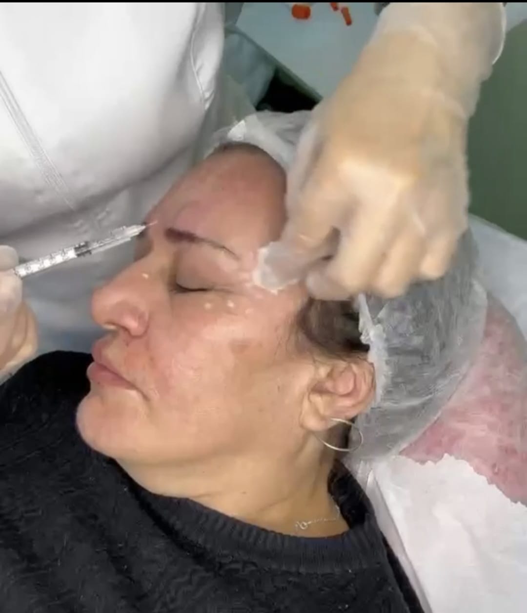 Botox