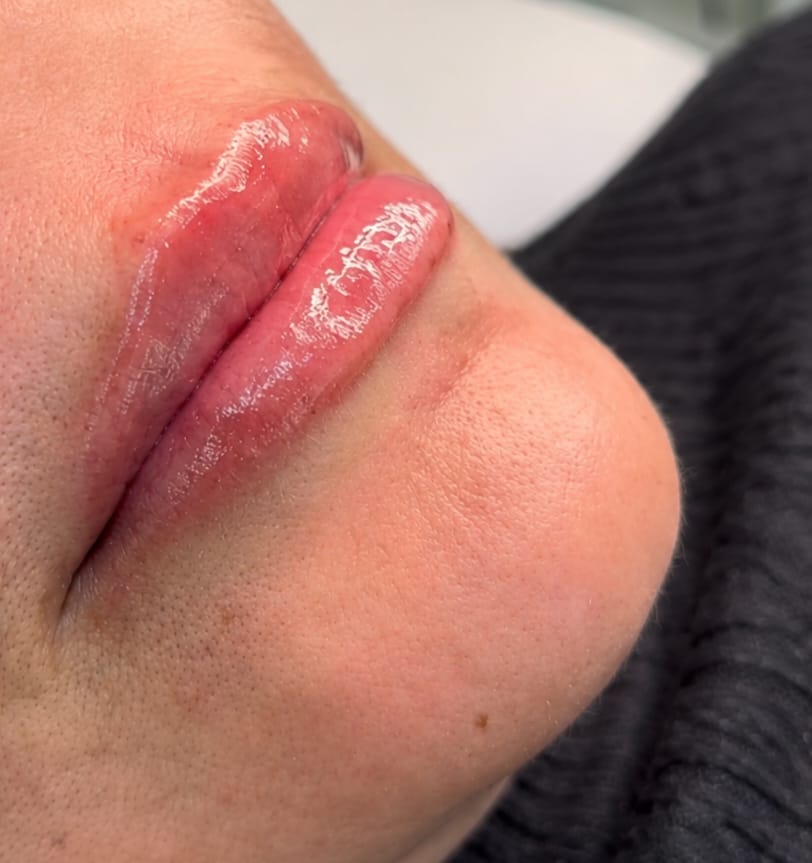 Preenchimento Labial