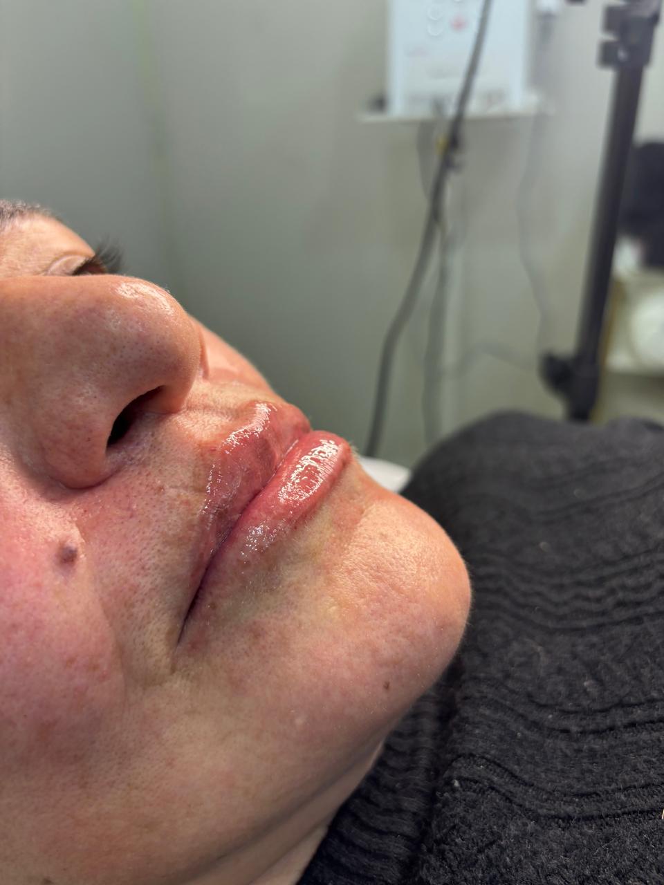 Preenchimento Labial